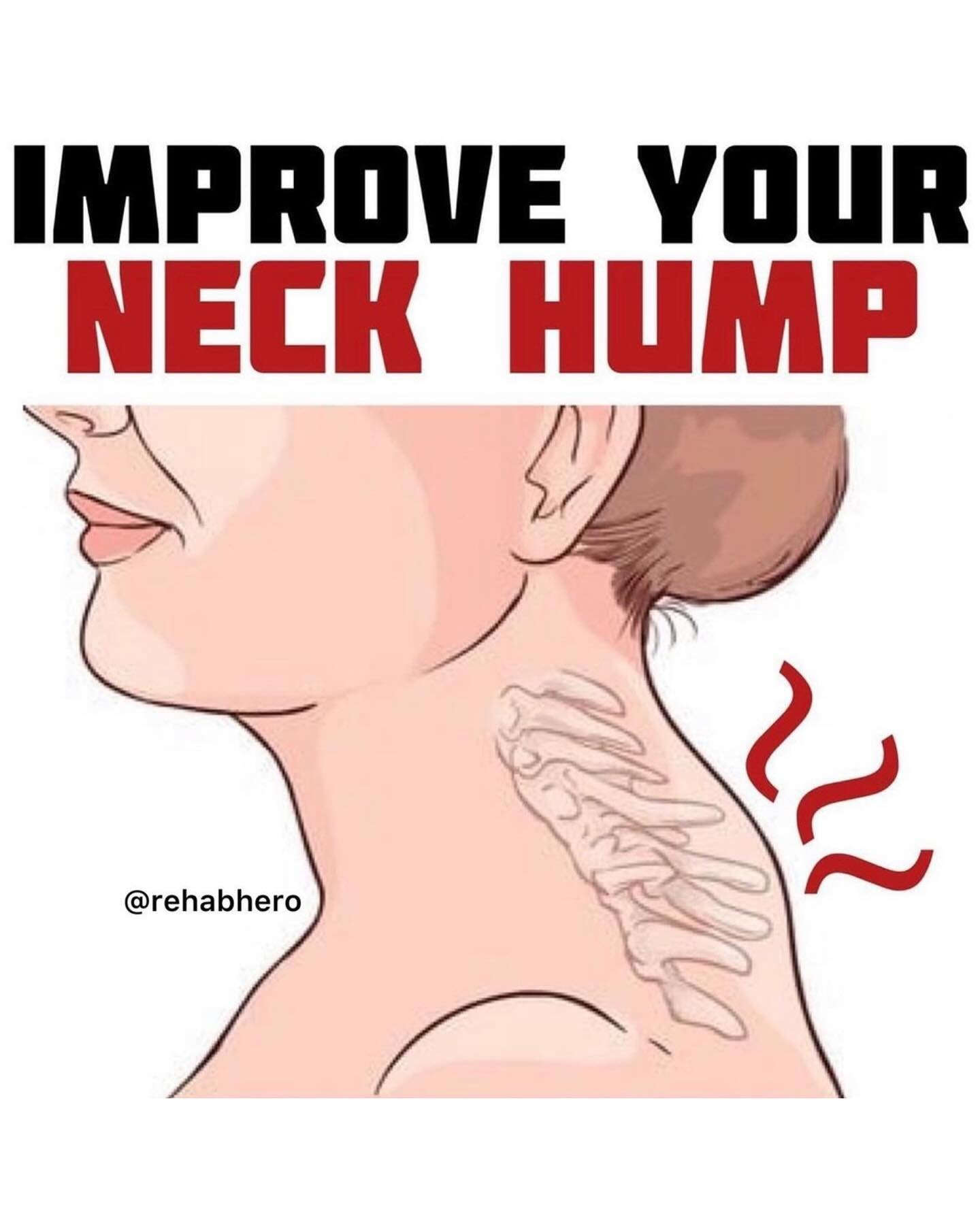 🚨NECK HUMP EXERCISES!🚨

Have you noticed that there&rsquo;s a hump right where your neck transitions into upper back? This hump is commonly known as Dowager&rsquo;s Hump, and typically it occurs with postural changes and aging. Having this hump doe