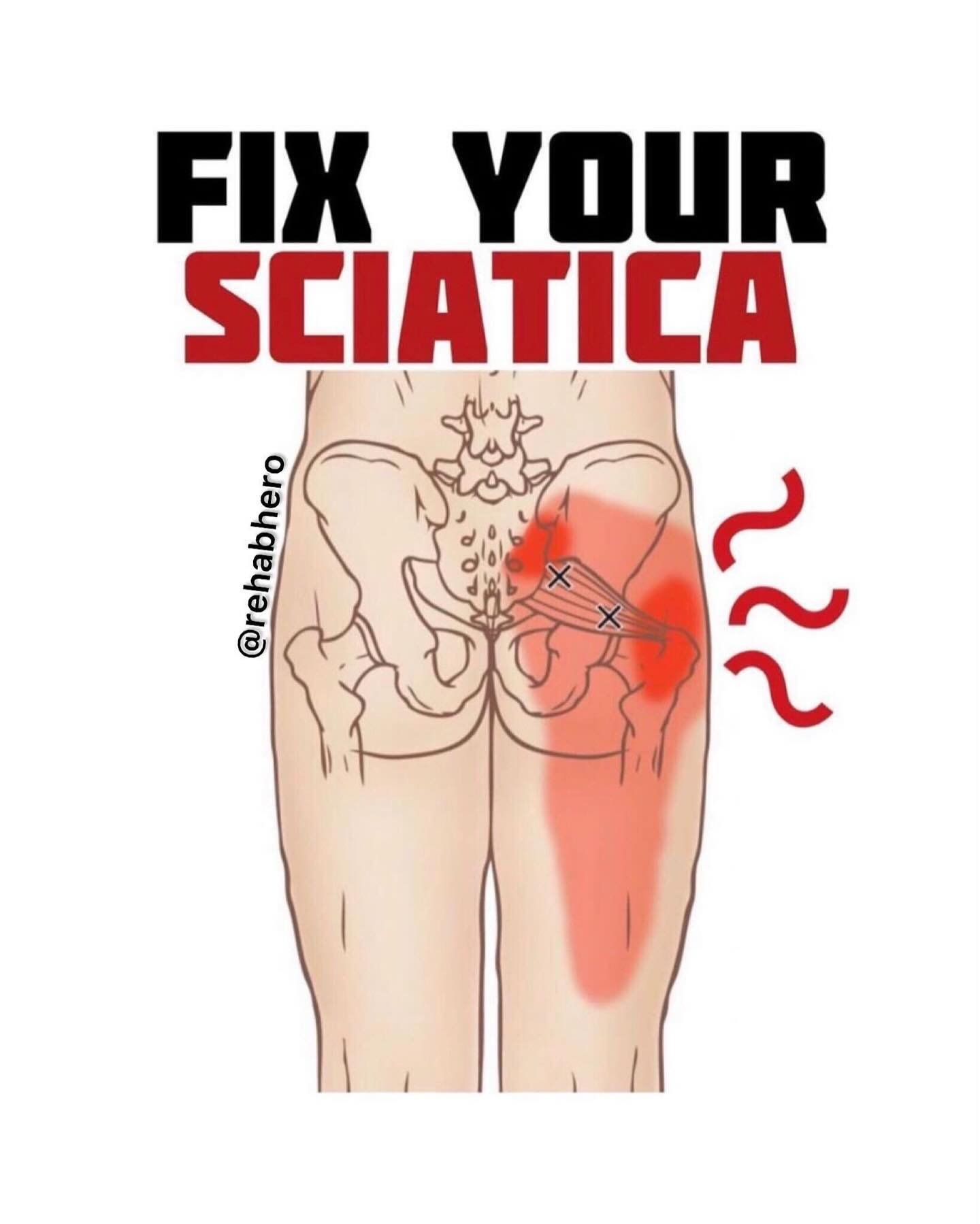 ⚡️Can Piriformis Syndrome cause Sciatica?⚡️

🍑The piriformis is a buttock muscle that has a few functions, while the hip is flexed it internally rotates and abducts the thigh, and while the hip is extended it externally rotates the hip joint. It als