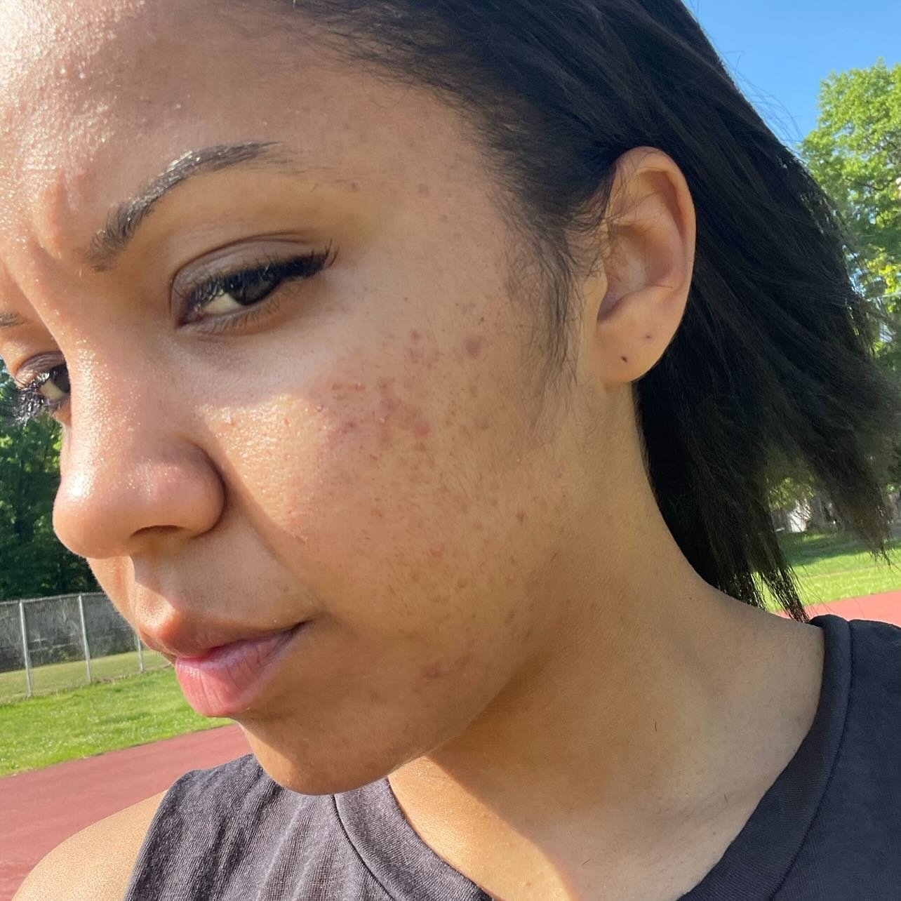 For as long as I can remember, acne has been a significant part of my life a challenge I struggled with not just physically, but emotionally as well. There were days when it felt like my skin issues defined me, impacting my confidence and the way I s