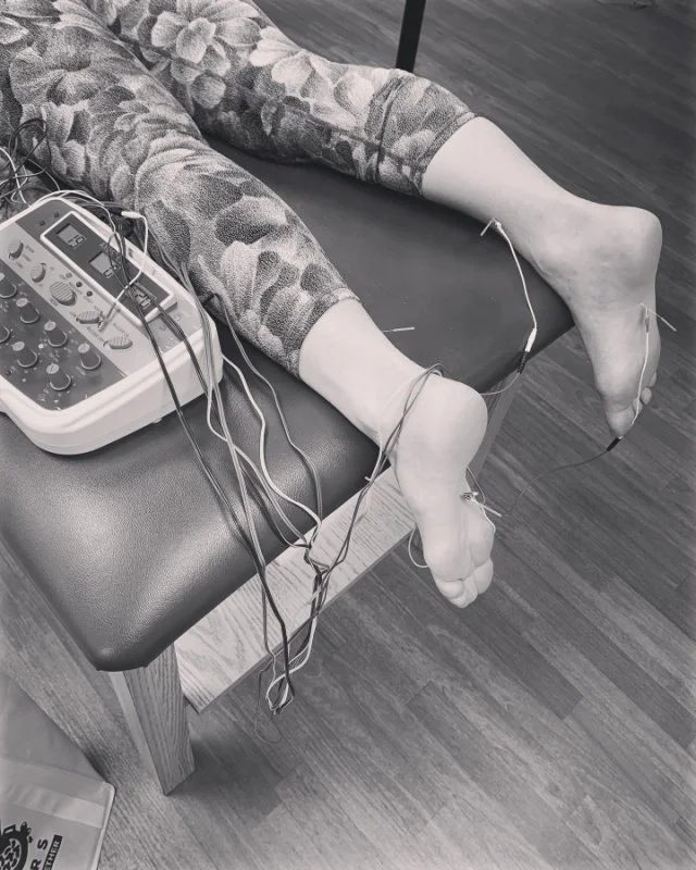 Dry Needling — A Life in Balance