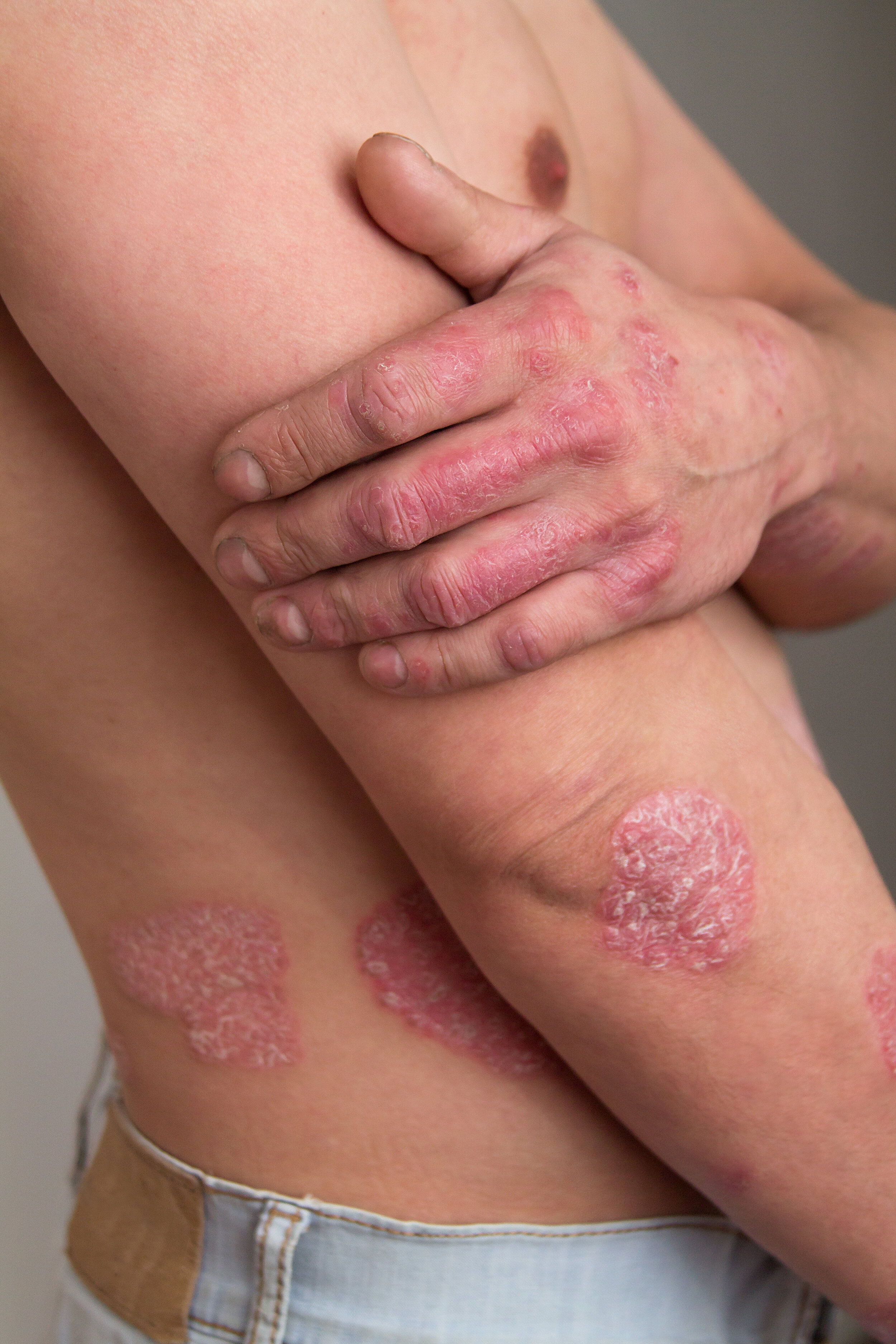 is psoriasis: a dominant or recessive gene