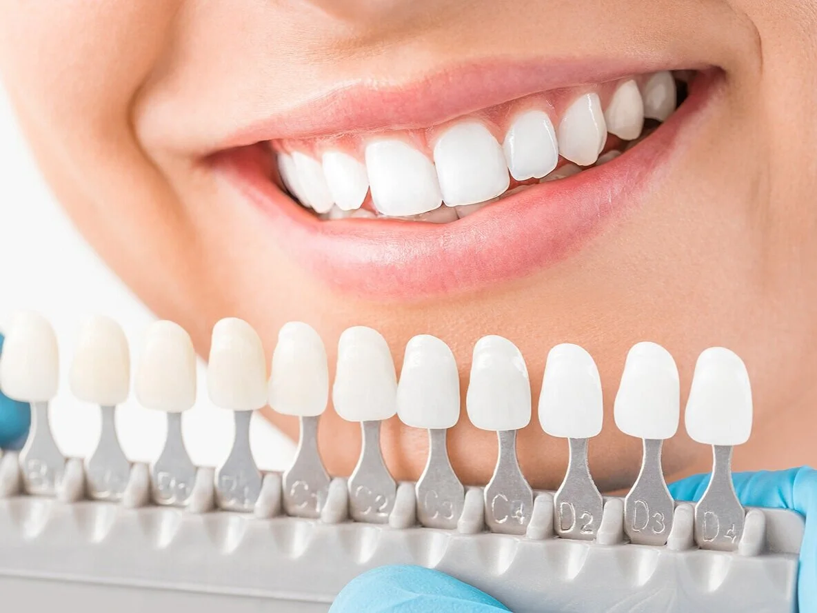 Teeth+Whitening