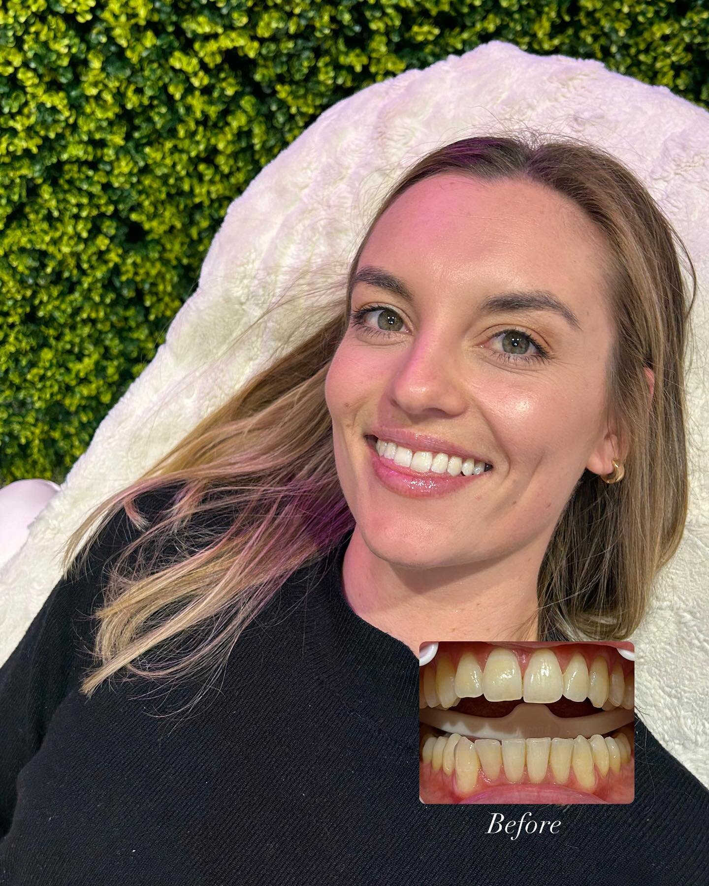 Our #tripletheglow treatment offers you the perfect confidence boost! Giving you a smile upto 12 shades whiter in just 60minutes! 

Book in with a friend today 🦷 

#teethwhitening #teethwhiteningauckland #teeth #glowup #auckland #ponsonby