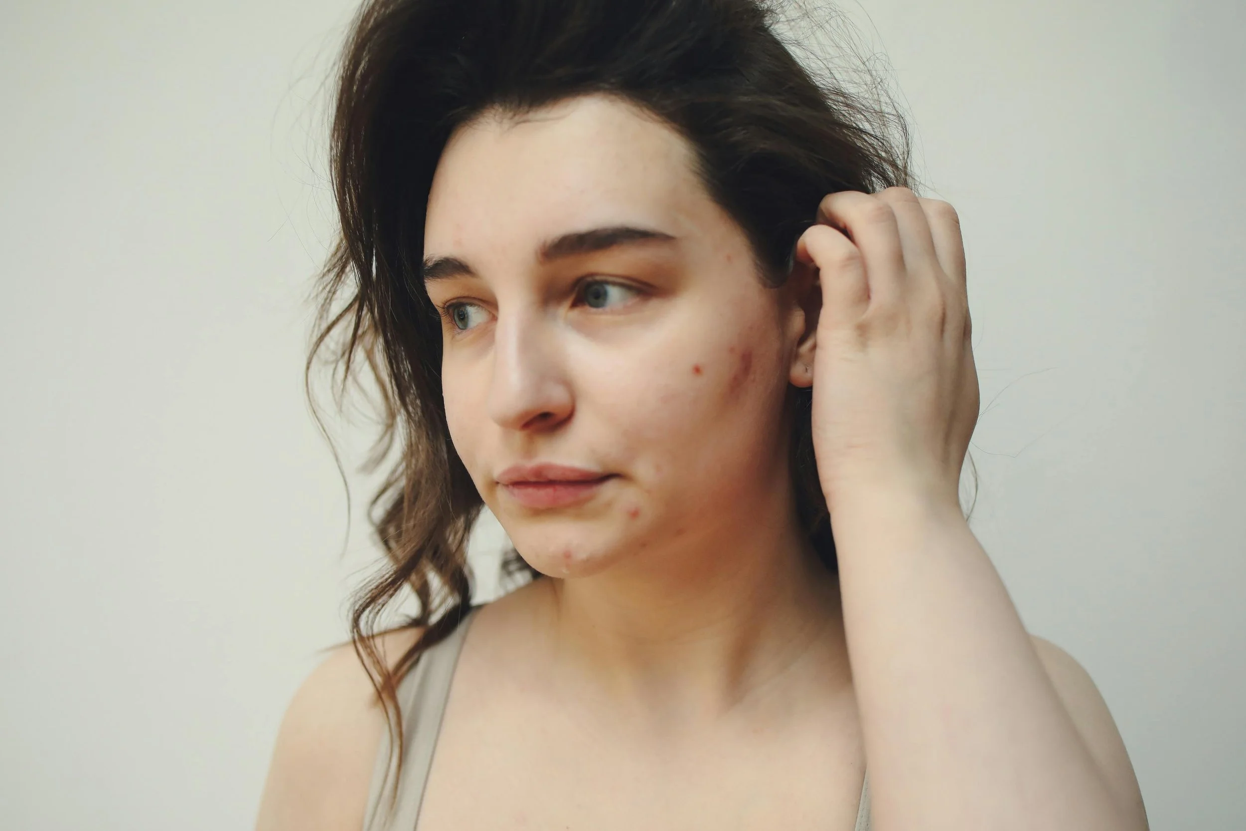 Exploring the Gut-Skin Connection in Acne: What the Latest Science Means for You