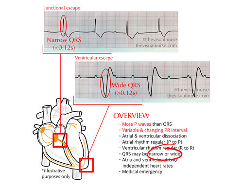 Complete heart block: why is the QRS narrow? — The Visual Nurse