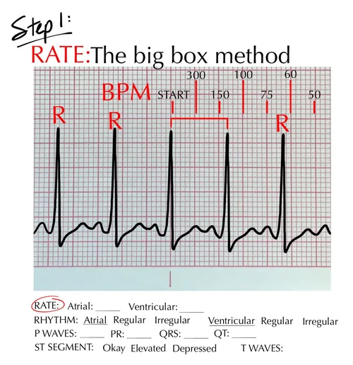 The big box method for HR determination on the ECG (for nurses