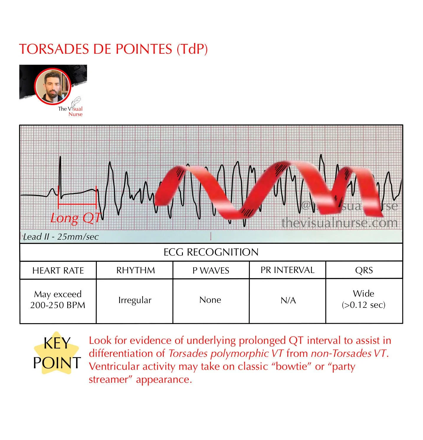 Torsades de Pointes (TdP) on the ECG for nurses & nursing students ...