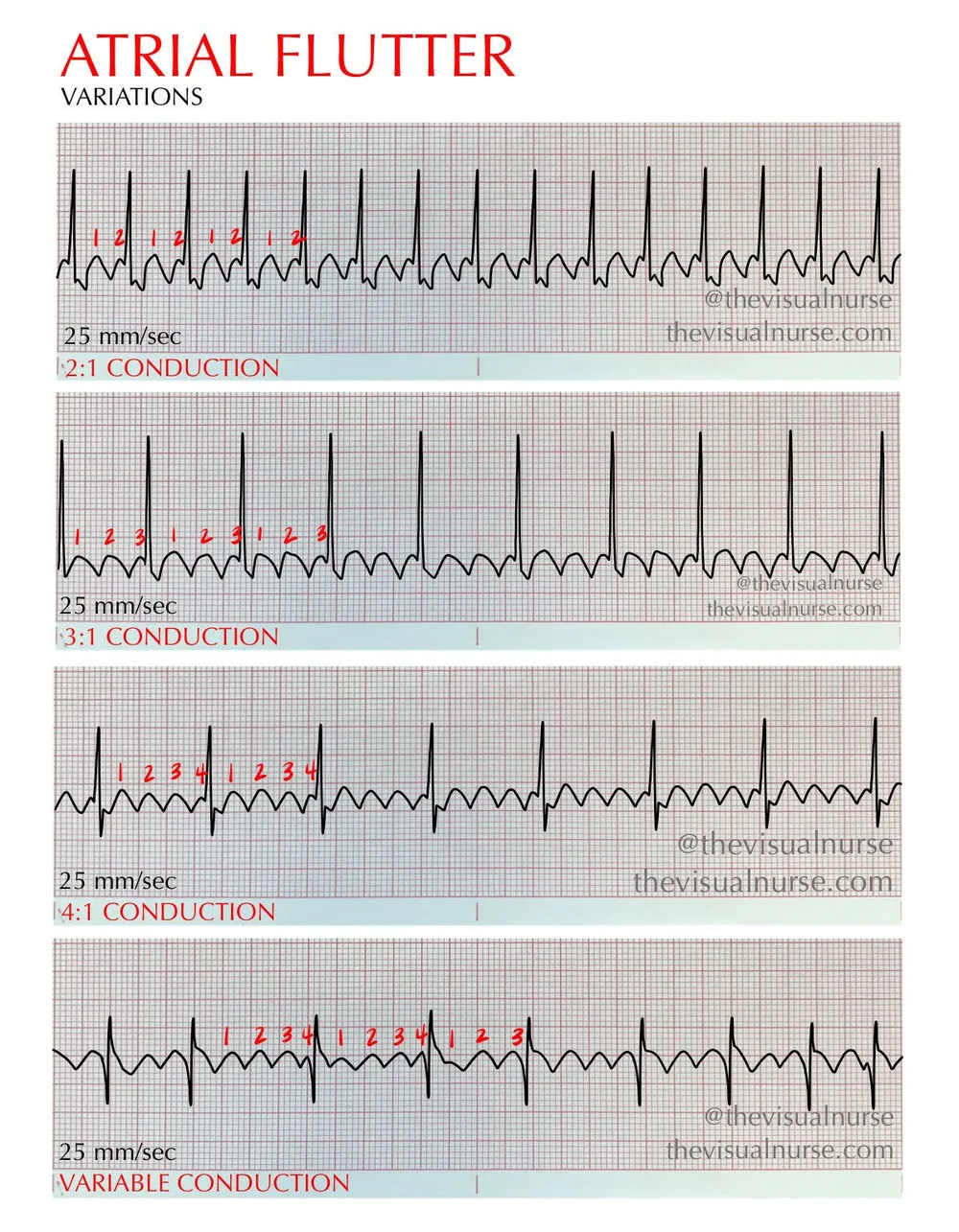 Atrial fibrillation vs. atrial flutter on the ECG for nurses & nursing ...