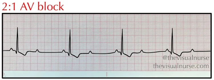 Second degree type II (Mobitz II) on the ECG for nurses & nursing ...