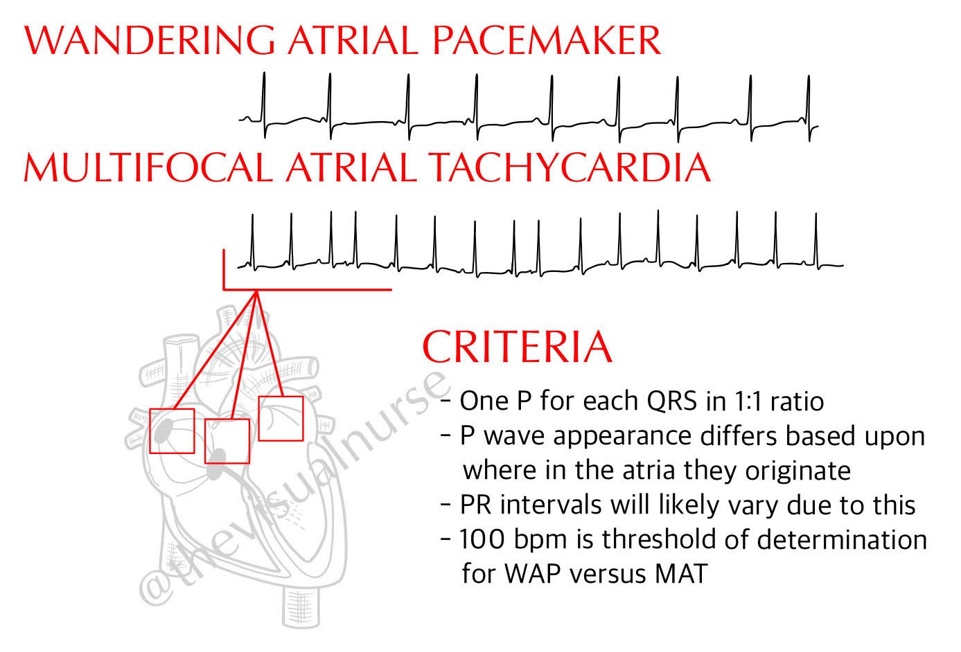 wandering atrial pacemaker vs mat