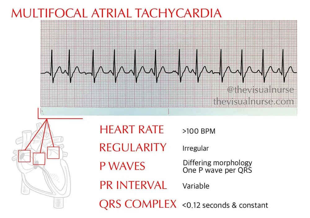 WAP vs. MAT on ECG What’s the difference? — The Visual Nurse