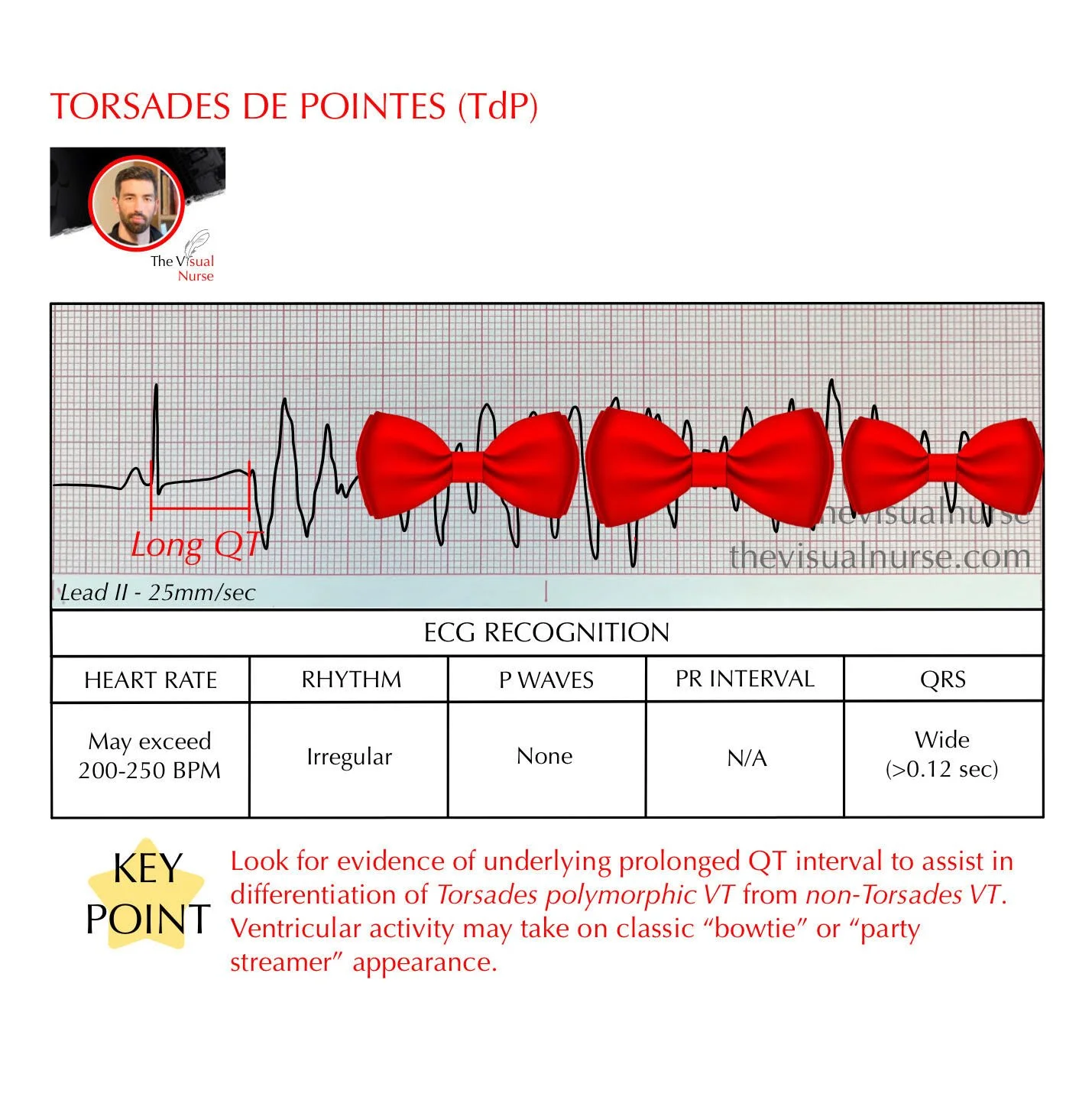 Torsades de Pointes (TdP) on the ECG for nurses & nursing students ...