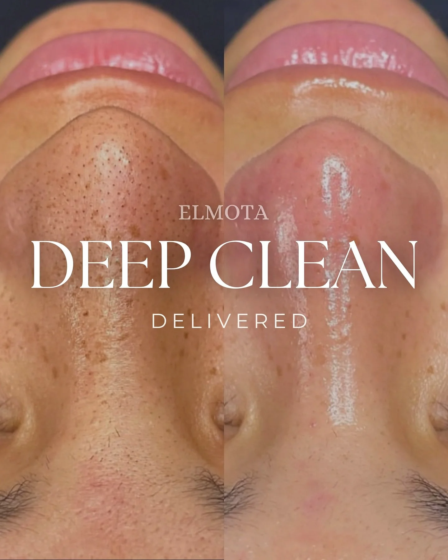 Pores don&rsquo;t shrink&mdash;
but when they&rsquo;re properly cleaned, they look noticeably tighter, smoother, and more refined.

At ELMOTA, strategic exfoliation and expert extractions work together to lift buildup, dissolve congestion, and reset 