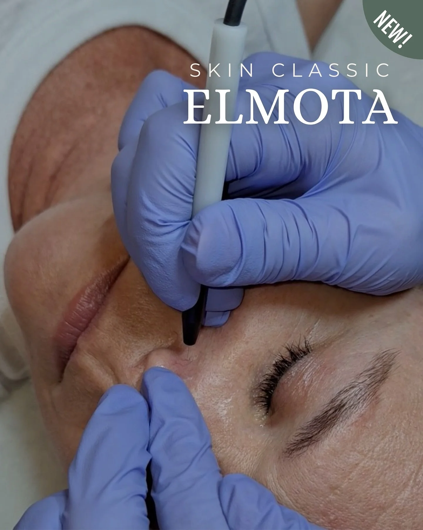 Skin Classic ~ 🆕 at Elmota 

A precise, non-invasive treatment designed to safely target and improve minor skin irregularities with minimal downtime. 

Using high-frequency technology, the Skin Classic delivers a controlled current that gently dehyd