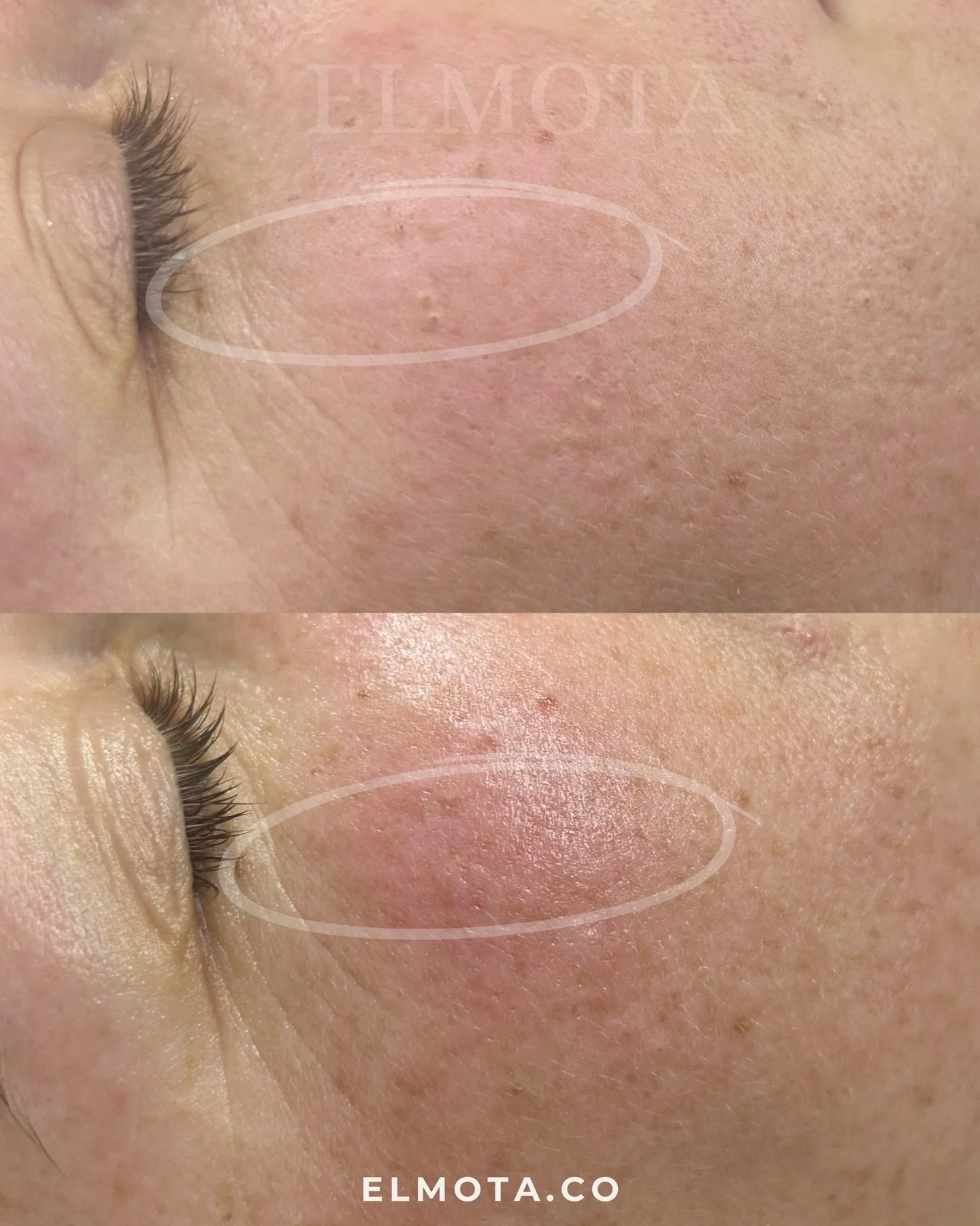 There&rsquo;s nothing quite like the feeling of a fresh, clean slate for your skin.

These before + after extraction results are more than just satisfying to see &mdash; they&rsquo;re a total reset for your pores. 

Deep congestion, stubborn buildup,