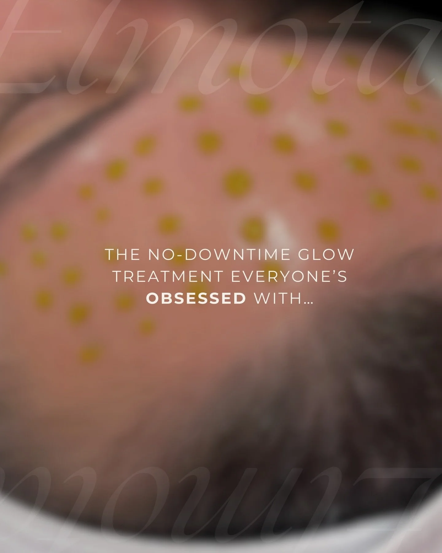 For a very limited time, Elmota is offering $50 off BioRePeel ✨
If you&rsquo;ve been curious&hellip; now is the perfect time to try it.

Glow without the downtime.

BioRePeel is that perfect in-between &mdash;
not a facial, not a traditional peel.

I