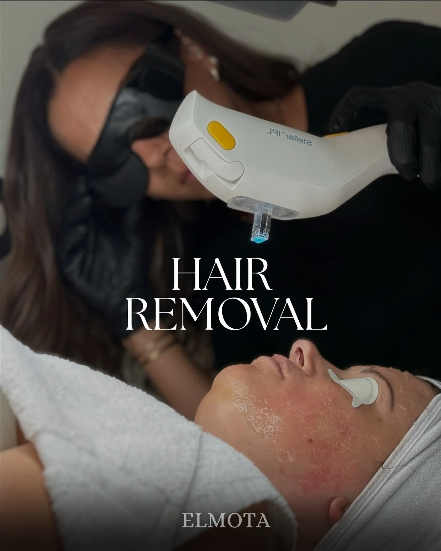 We know&hellip; talking about summer when it&rsquo;s freezing outside feels a little crazy. But that&rsquo;s exactly why we start laser hair removal now‼️

Hair grows in cycles, which means laser works best over a series of sessions &mdash; not overn