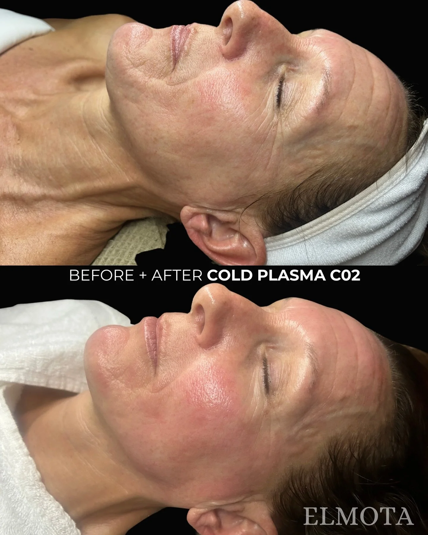 The glow is instant&hellip; but the science runs deep ✨

This is the power of our Cold Plasma + CO2 treatment&hellip;working beneath the surface to stimulate collagen, calm inflammation, and restore your skin&rsquo;s natural GLOW.

Cold plasma uses a