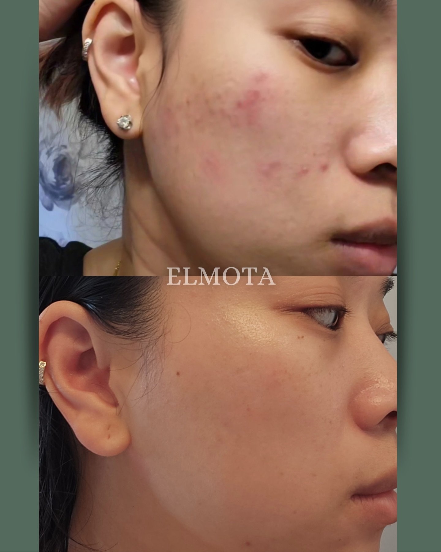 Real skin.
Real results. 
One session.

After struggling with ongoing acne, this client saw a noticeable shift in overall clarity, redness, and texture after just ONE plasma treatment.

ℹ️Plasma works differently by using ionized energy to stimulate 