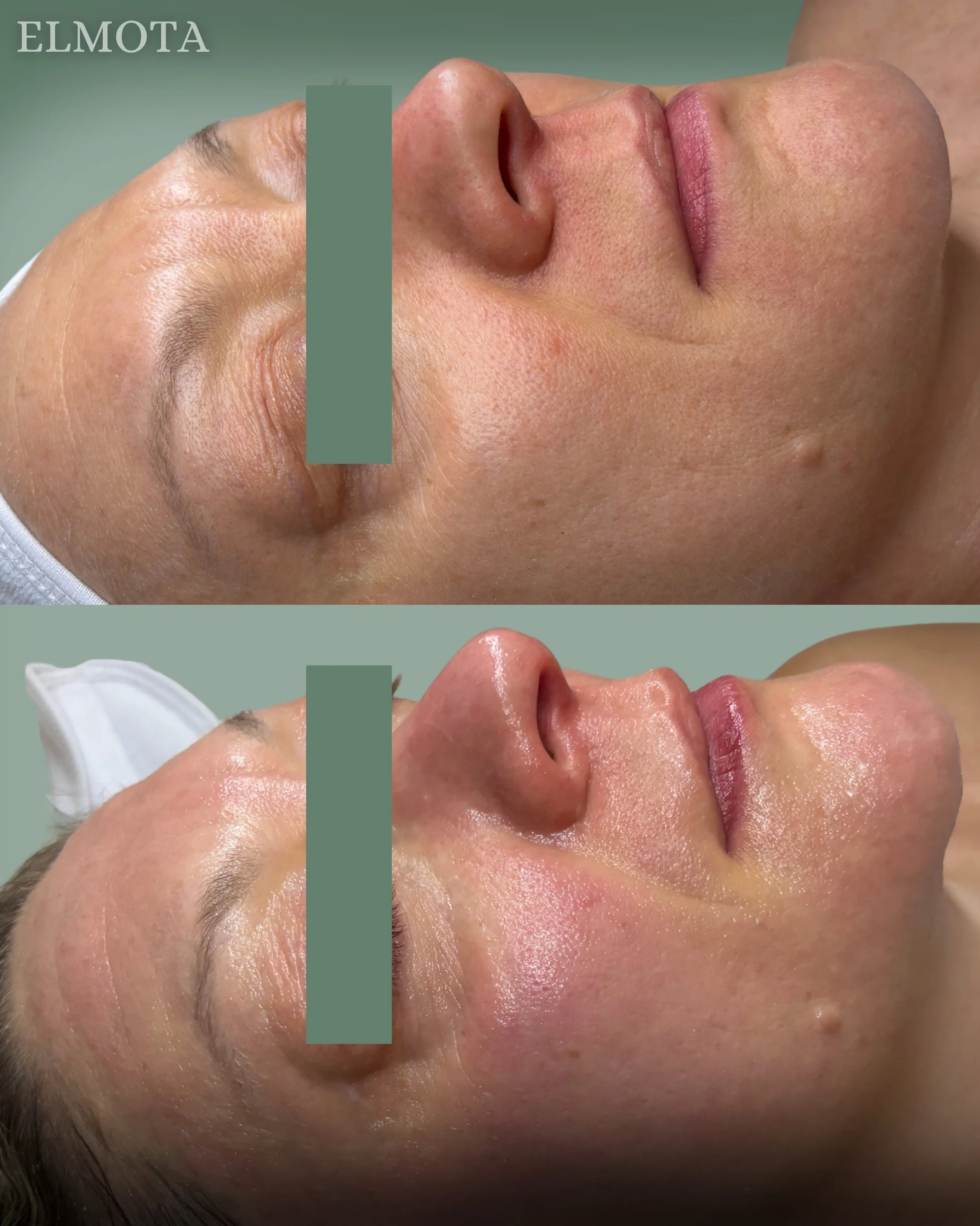 One cold plasma treatment and the glow speaks for itself ✨

Smoother texture, brighter skin, and that fresh healthy glow our clients keep coming back for. Cold plasma is quickly becoming a favorite for a reason.

Book an appointment and check it out 
