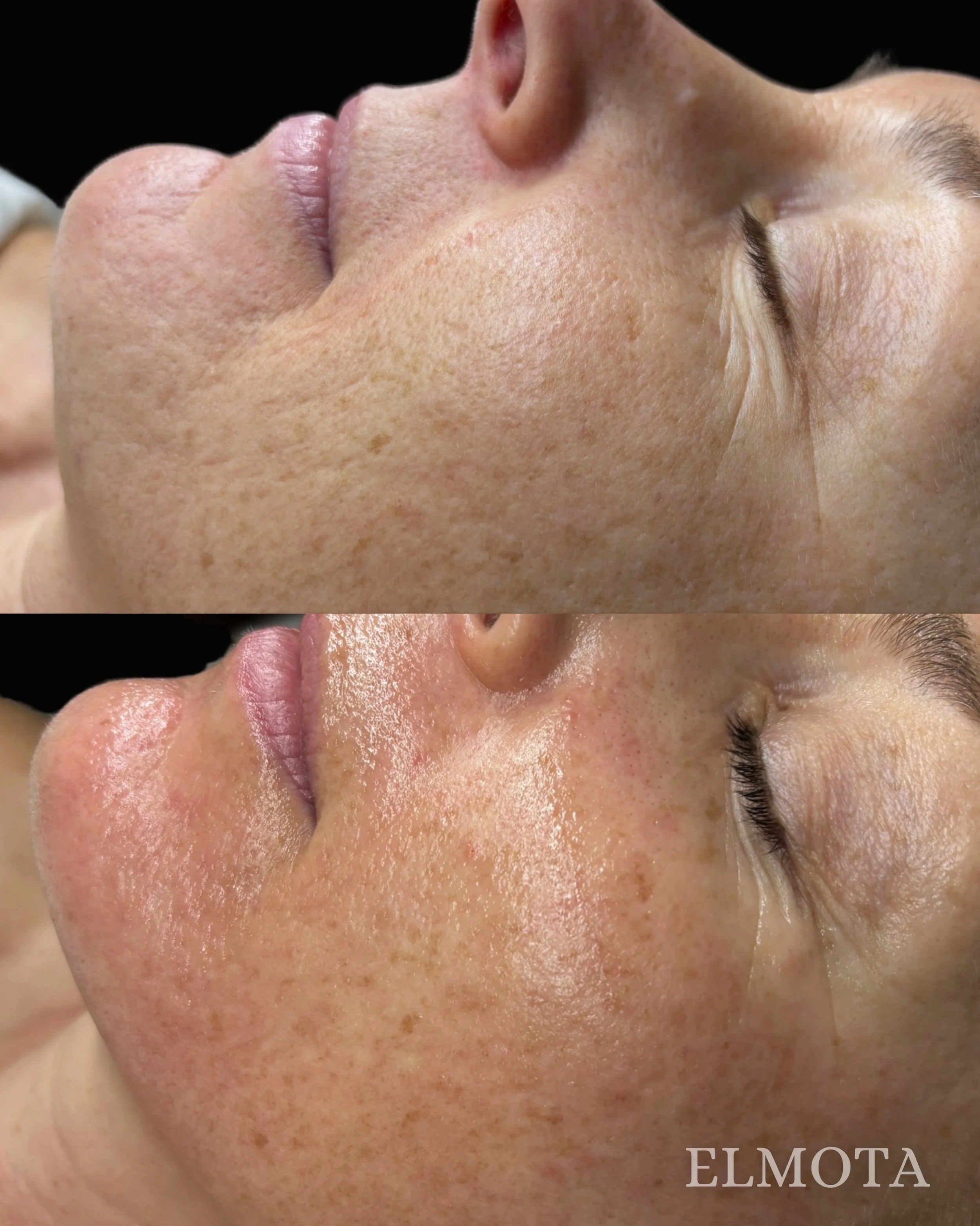 Texture. Tone. Collagen. ✨

This gorgeous before + immediately after microneedling treatment is just the beginning. We targeted texture and fine lines around the mouth and cheeks to help stimulate collagen, smooth the skin, and create that plump, ref