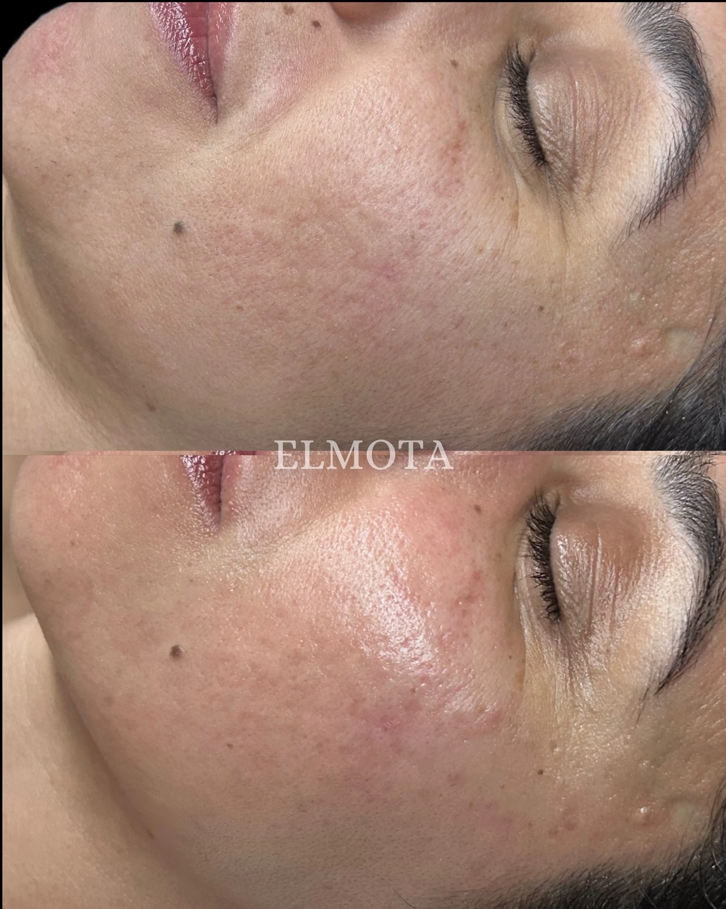 Our skilled aestheticians do it again!👏

These before and afters are immediately after our DermaZen Facial with an Ultrasonic Add On, and the results speak for themselves. 

Skin looks calmer, brighter, more hydrated, and visibly refreshed with a he