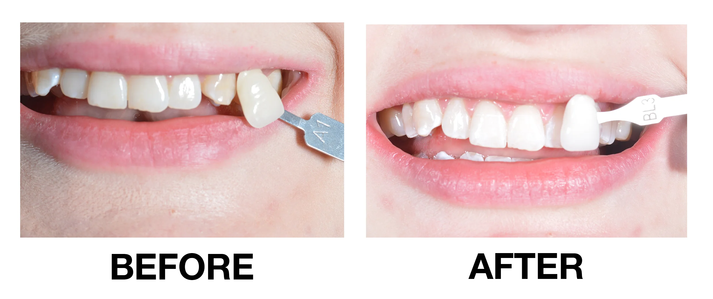My Teeth Whitening Experience with Cherrybank Dental Spa*