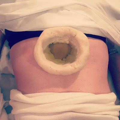 Traitement des douleurs lombaires et sciatique, kati basti