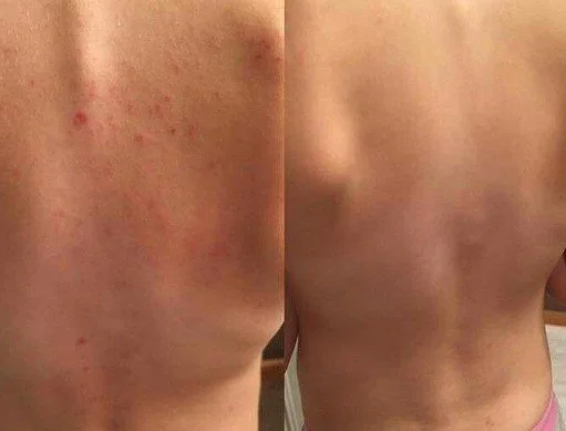 eczema12.jpg