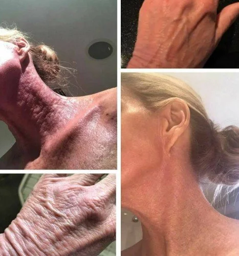 eczema7.jpg