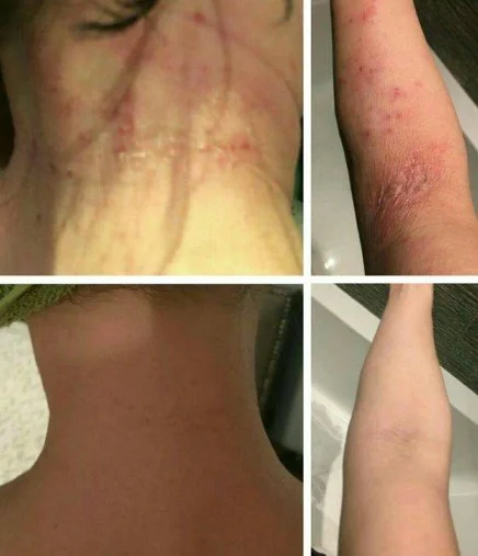 eczema9.jpg