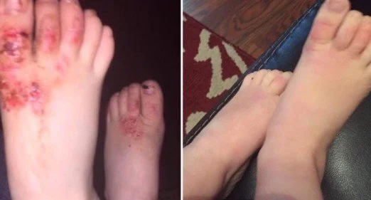 eczema15.jpg