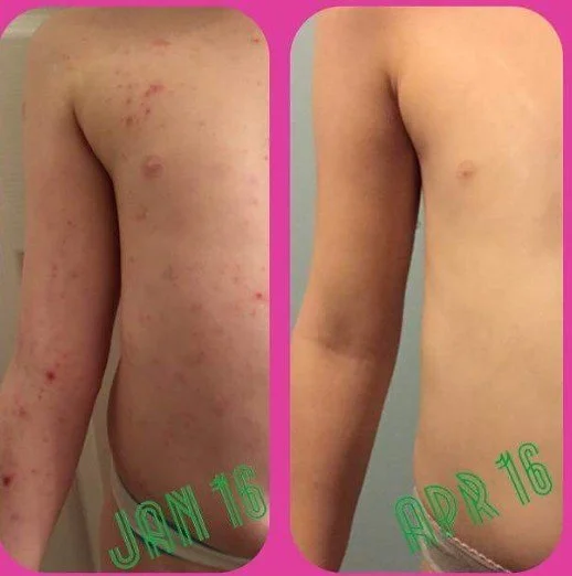 eczema17.jpg
