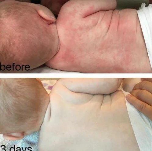 eczema11.jpg