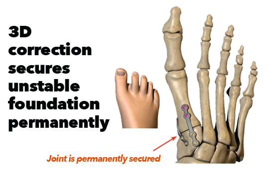 Podiatry Foot and Ankle Institute offers Lapiplasty® 3D Bunion Correction 