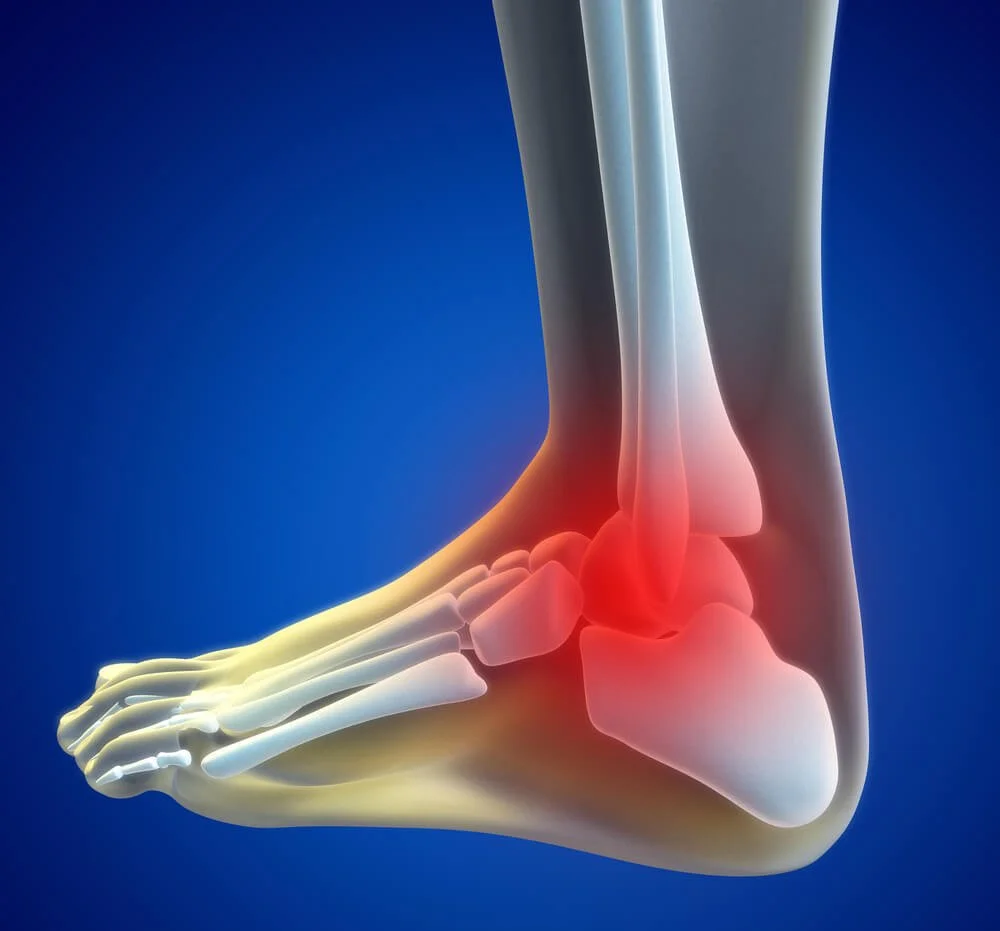 Ankle Injury - Talus Fracture