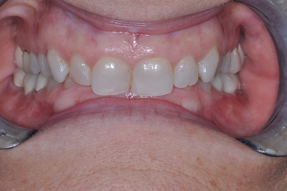 Before Teeth Grinding Treatment