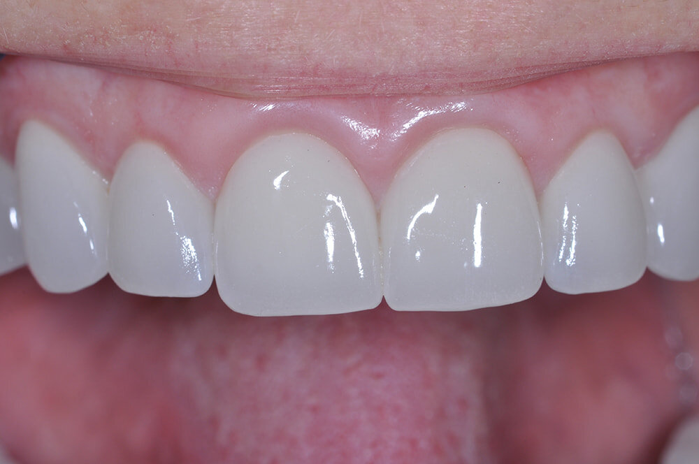 After Teeth Grinding Treatment