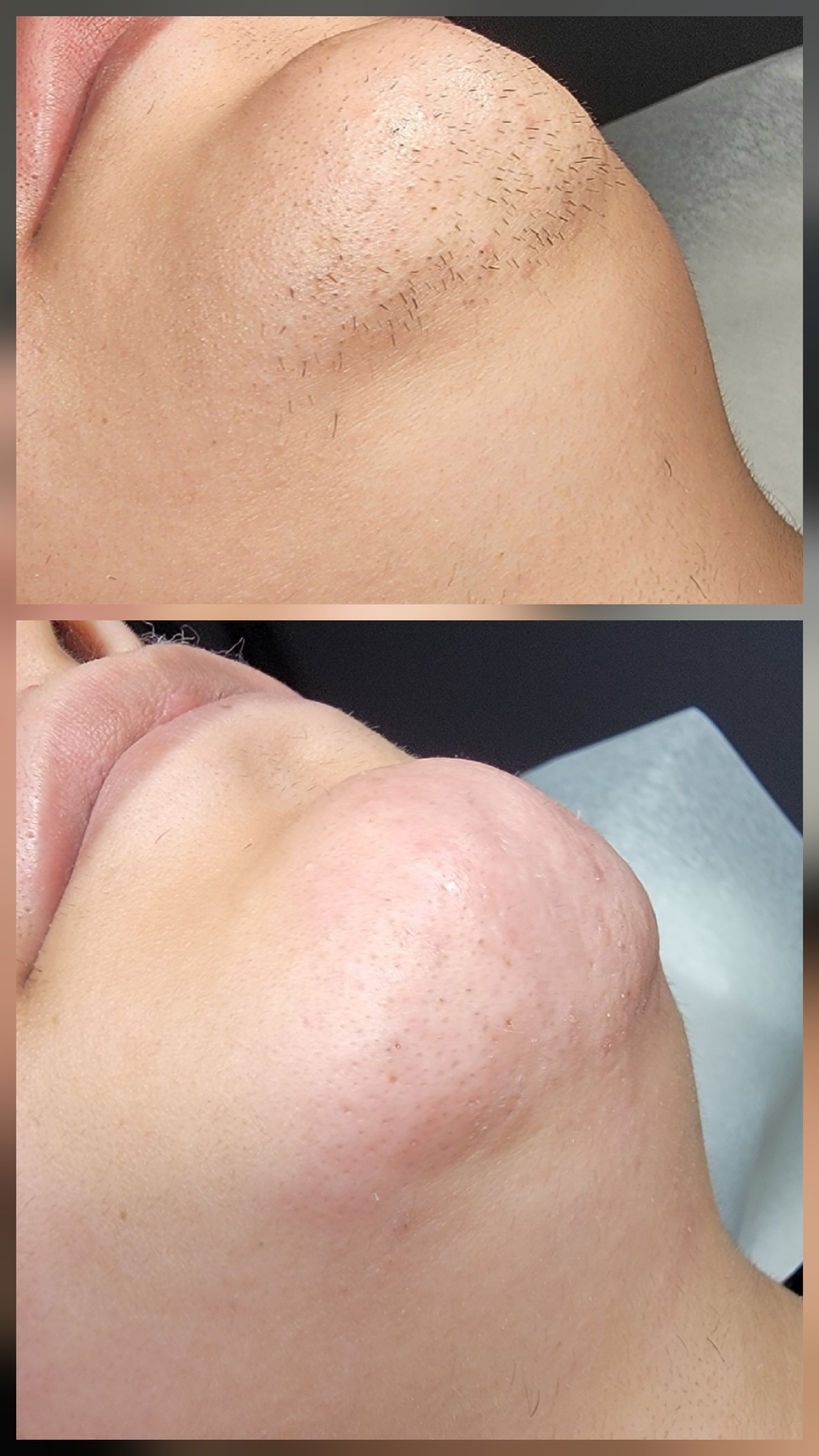 Electrolysis chin