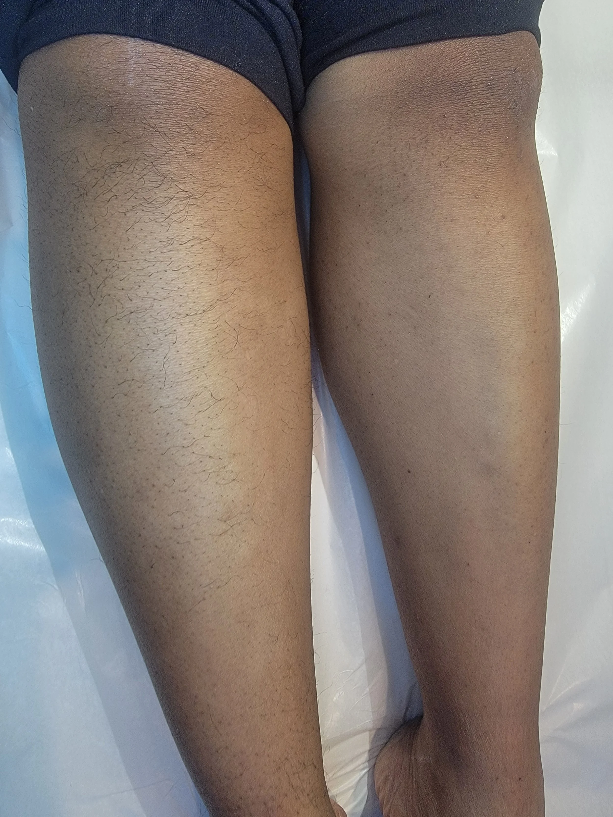 Electrolysis legs