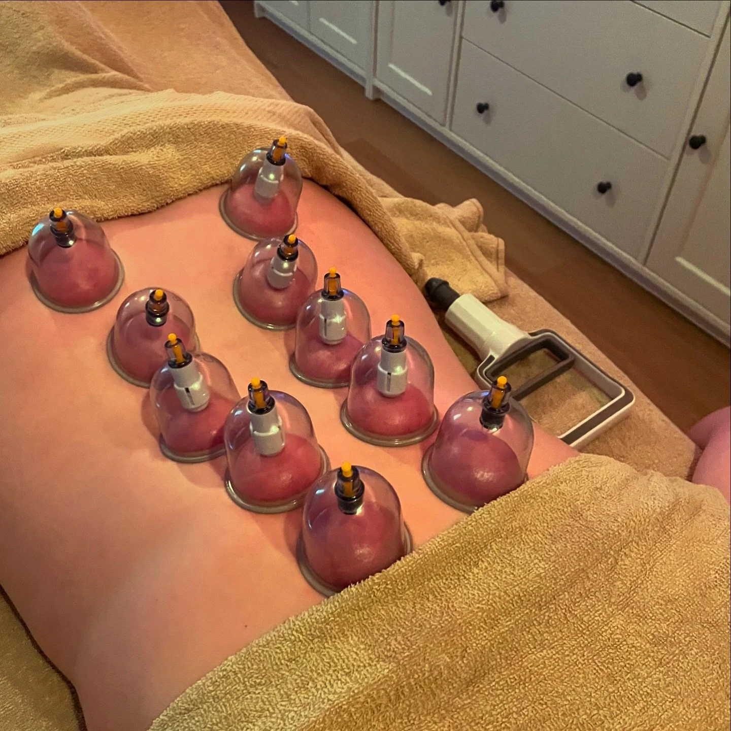While Ayurveda does traditionally incorporate practices similar to cupping, it isn’t as prominent as in traditional Chinese medicine. Ayurvedic treatments like ‘Raktamokshana’ (bloodletting) involve techniques that draw out impuriti