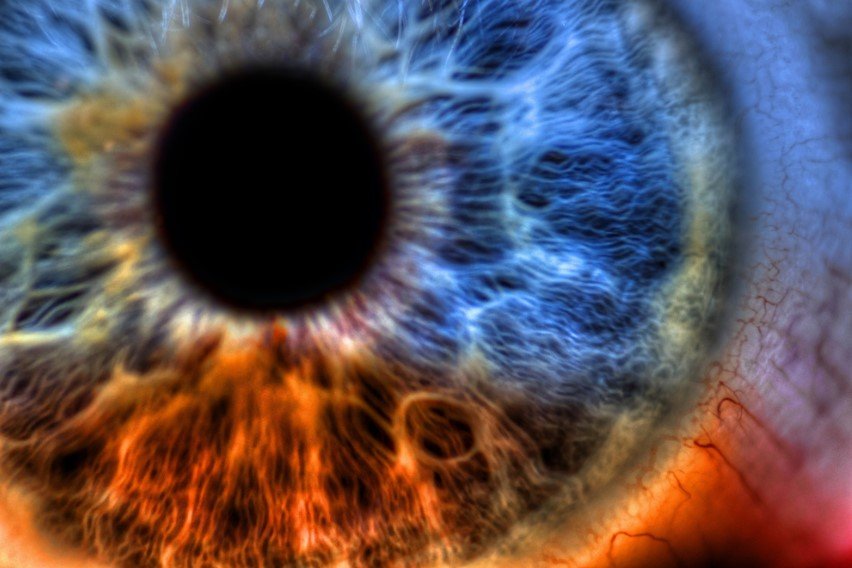 Sub Conjunctival Hemes