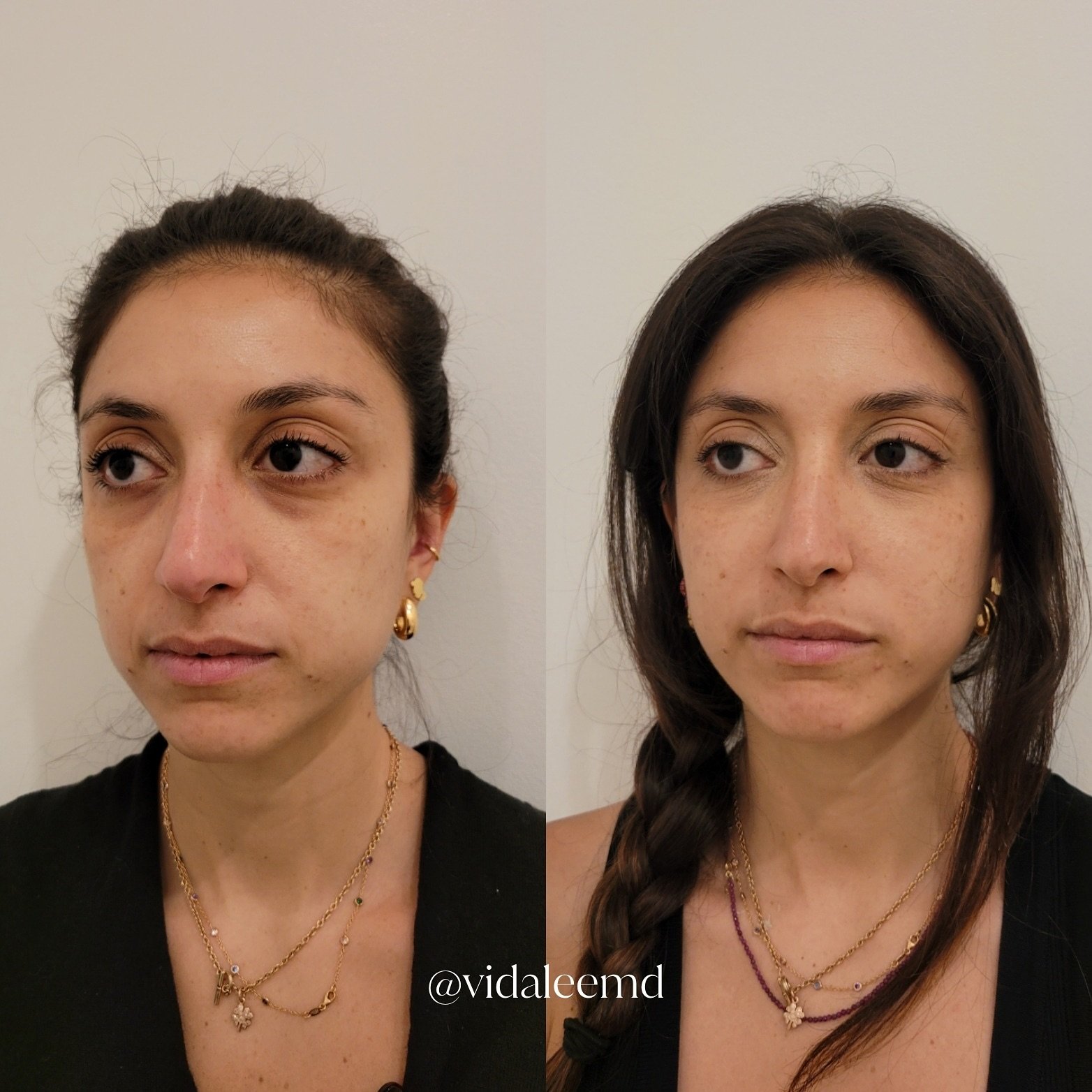 Lifted &amp; Brightened - I am obsessed with this patient&rsquo;s results!⁠
⁠
This client&rsquo;s B&amp;A shows just how much youthfulness and life can be restored to your face with a little filler and a great skincare regimen.⁠
⁠
She received my cus