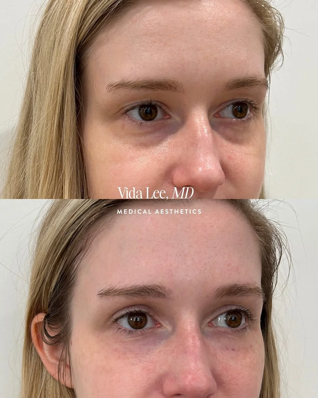 ✨ Sleep helps&hellip; but filler works faster.⁠
⁠
My patient is a busy mom, and no amount of sleep or concealer was going to give her these results. Because often the tired look doesn&rsquo;t come from late nights&mdash;it comes from volume loss unde