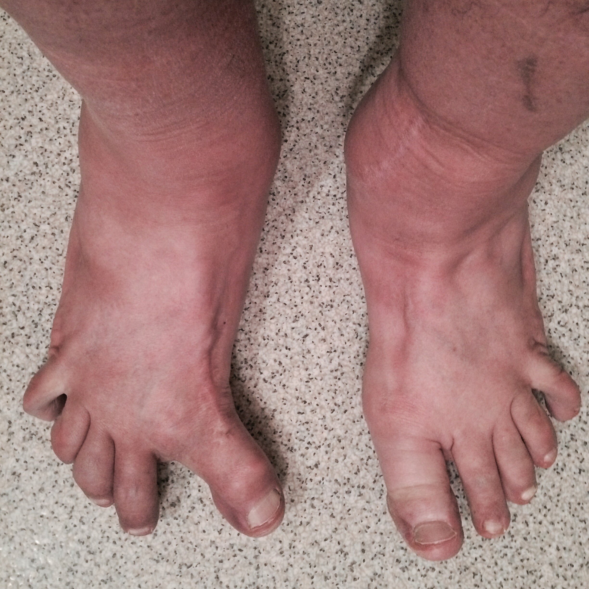 Born with flat feet, nine broken bones in my feet, eight bone spurs removed, bunion, hammertoes, ankle in four, tibia, ACL, pelvis. By 2021 I had tried every boot solution and could no longer tolerate anything, I have a limp and slow gait but at leas