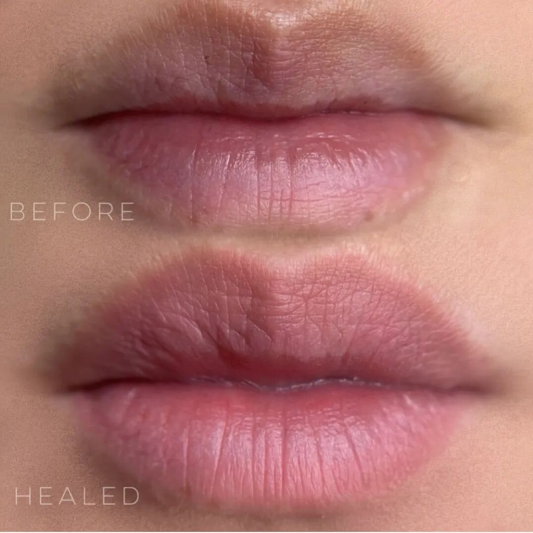 We are here for @lipblushbaby 's 🅗🅔🅐🅛🅔🅓 lippiez!!!! 🥵🔥🩷🩷🩷 A beautiful example of healed results of lip neutralization ✨