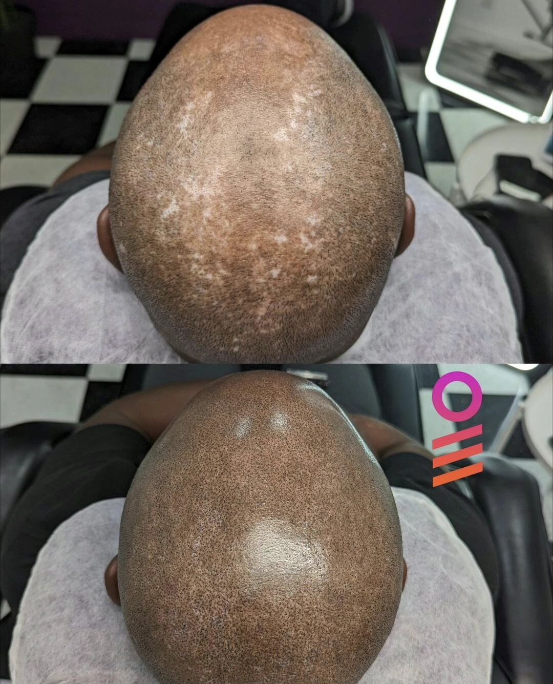 Amazing #vitiligo SMP session went down today with @theinkbarber !!!

Scalp Micropigmentation done by Shannon at @ink.barber 💈🔥

#hairlosssolution
#scalptreatment
#scalpmicropigmentation #micropigmentation #smpvancouver #scalptattoo