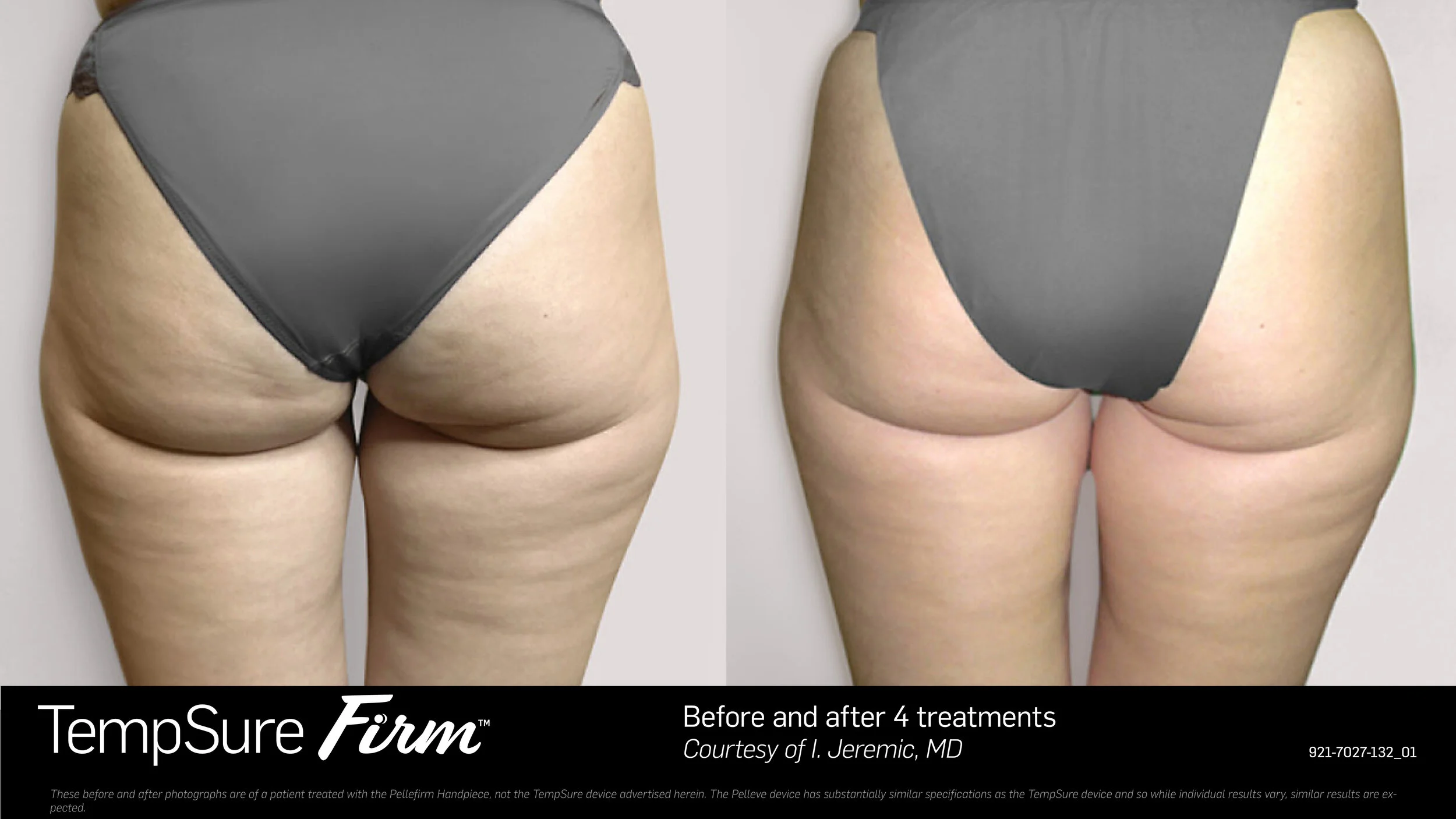 TempSure_Firm_BA3.jpg