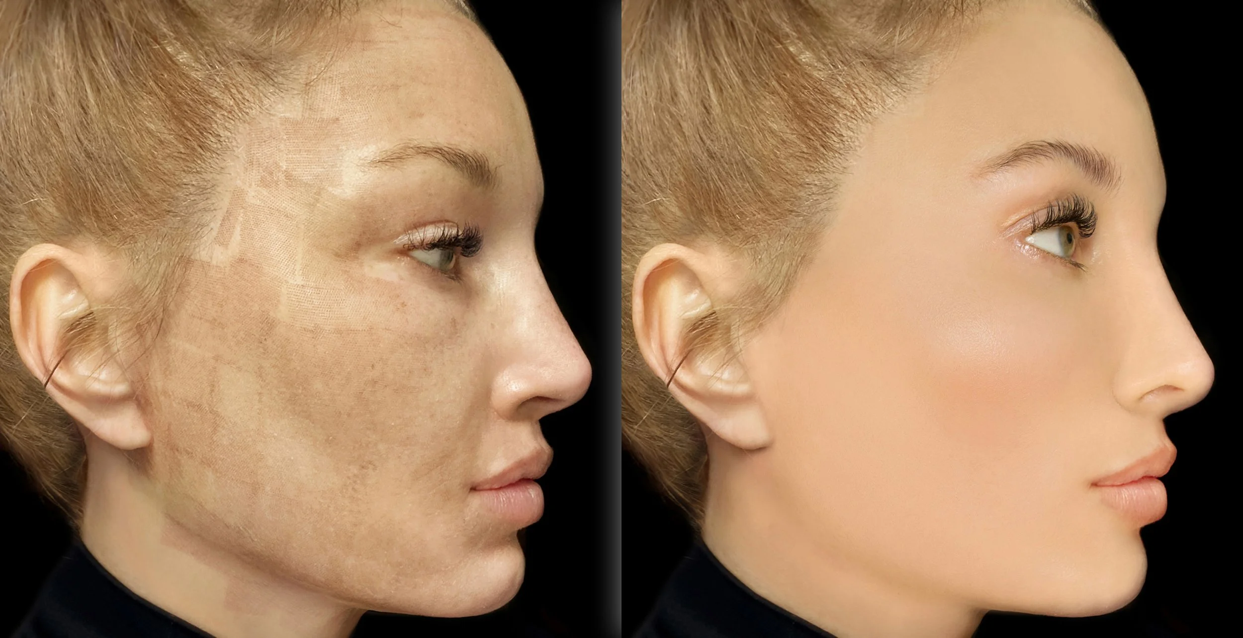 Side-by-side comparison of a woman's face before and after CO2 laser resurfacing skin treatment, showing smoother, clearer skin after.