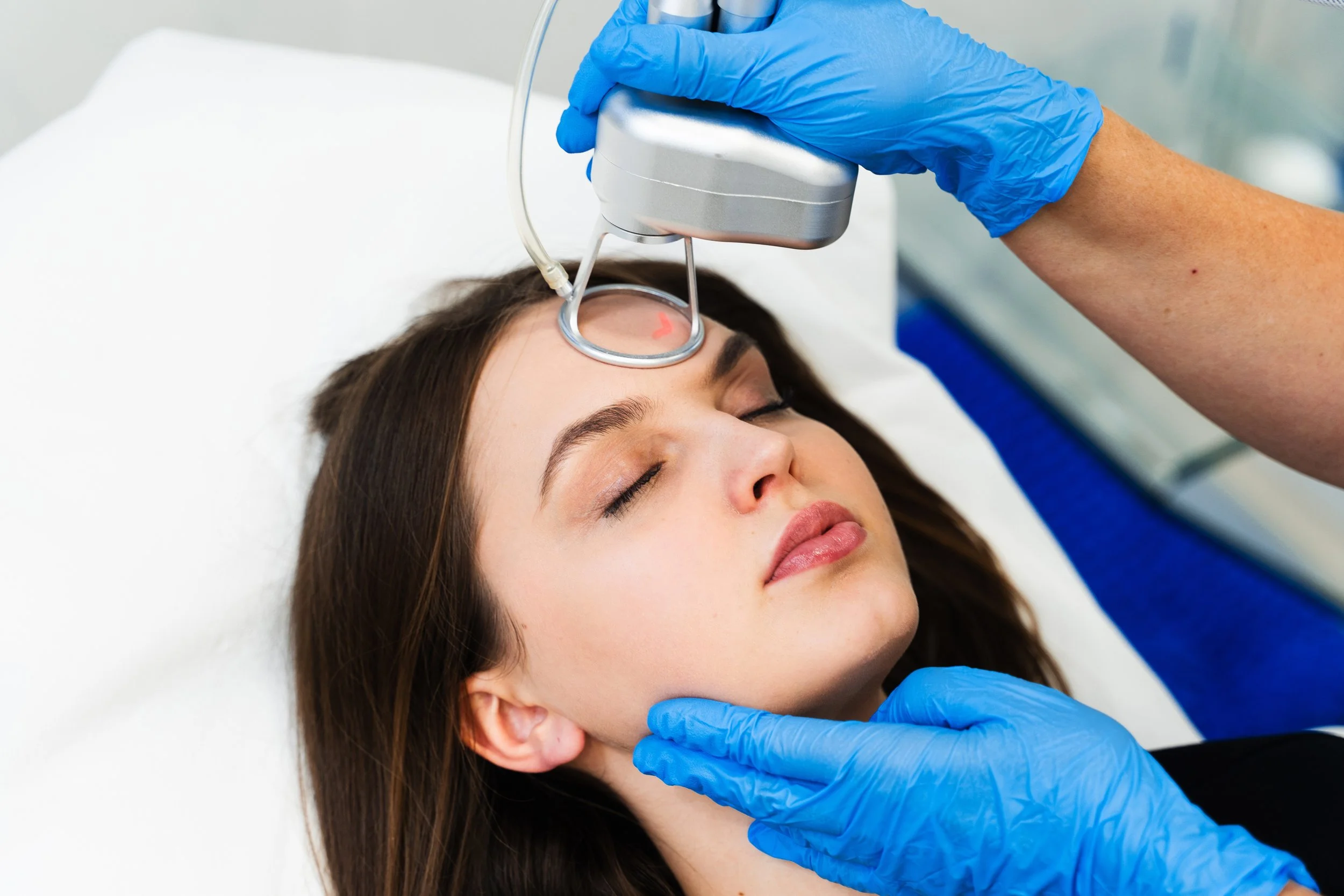 A woman with brown hair lying down during a CO2 laser resurfacing skin treatment while a healthcare worker in blue gloves holds a device against her forehead.